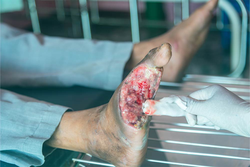Diabetic foot ulcers on a patient.
